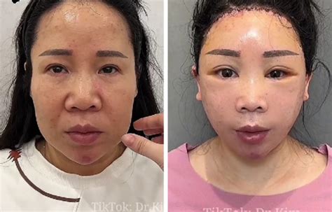 A Plastic Surgeon Goes Viral For His Transformation Videos Bright Side