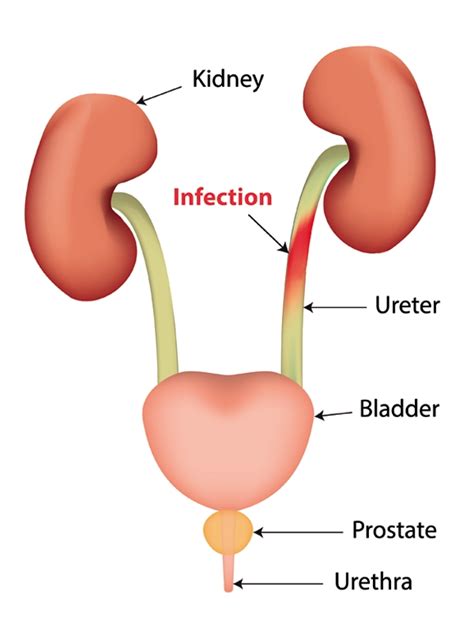 Urinary Tract Infection Complicated Signs And Symptoms Mims China