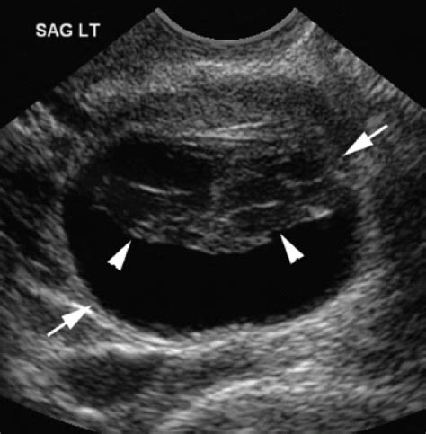 Ovaries And Adnexa Obgyn Key