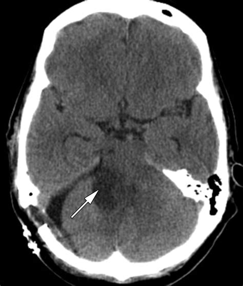 Radiology Vestibular Schwannoma at Jeff Updike blog