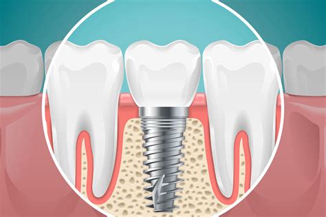 Dental Implant Vs Bridge Jm Dental Of Westbury