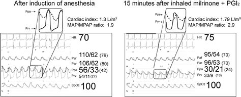 Preliminary Experience With Combined Inhaled Milrinone And Prostacyclin