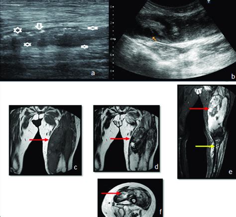 A And B Anterior Leg And Calf Grey Scale Ultrasound Images In Two