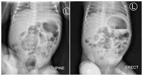 Double Bubble Duodenal Atresia