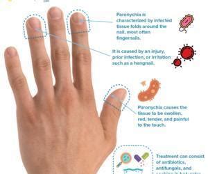 Paronychia (Nail Infection): Types and 5 Ways to Treat Paronychia