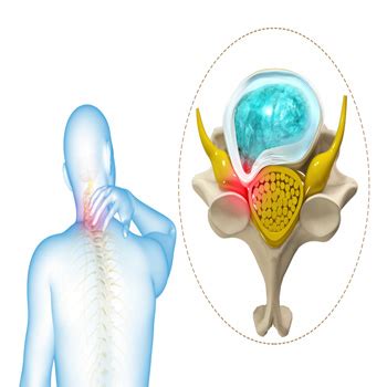 Cervical Myelopathy | Seacoast Orthopedics & Sports Medicine ...