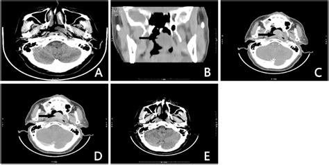 Preoperative CT scans showing a large tumor in the nasopharynx. (A ...