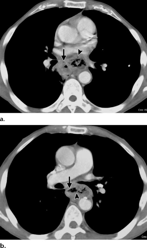 Acute Mediastinitis In A Patient With Esophageal Perforation A