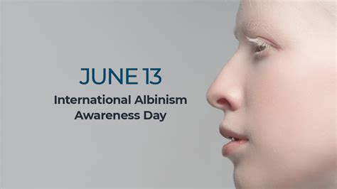 How Common Is Albinism And What Gene Causes It Infographic News Al