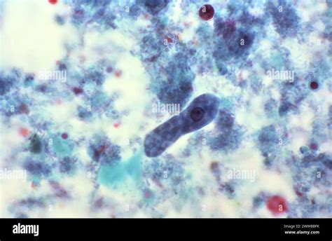 This Photomicrograph Of A Trichrome Stained Specimen Revealed The Presence Of A Typical