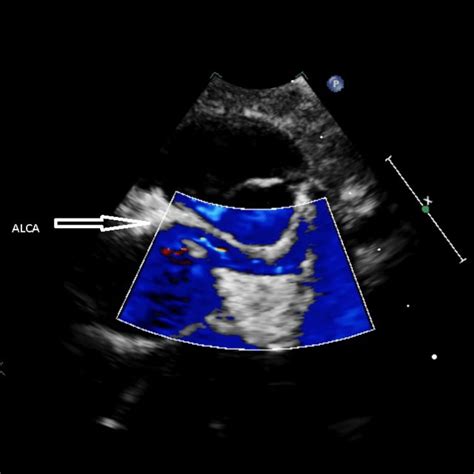 Parasternal Short Axis Image With Color Doppler Demonstrating Download Scientific Diagram