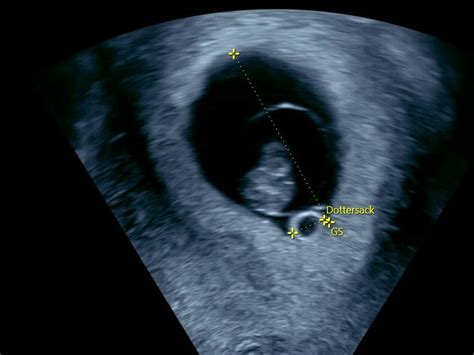 Ultraschall 6 0 Bis 8 0 SSW Frauenarzt Mertens De