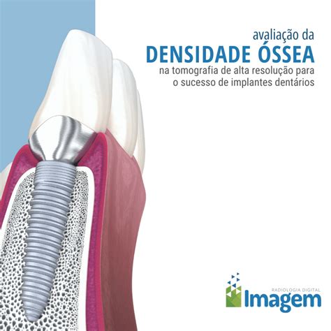 Avaliação Da Densidade Óssea Imagem Radiologia