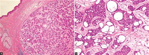 Primary cutaneous cribriform apocrine carcinoma: Case report and ...