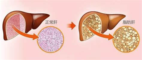 脂肪肝与代谢综合征的关系：一种潜在的恶性循环 肖瘤医生互联网医院在线问诊平台