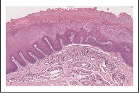 Figure 3 From Oral Hairy Leukoplakia In HIV Negative Patients Report