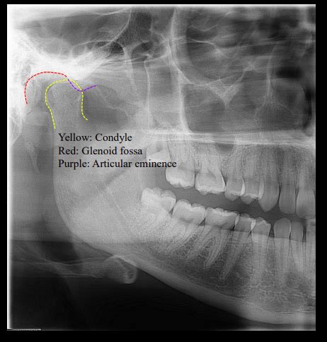 D2 Radiology Panoramic Radiography Errors Principles Of Image