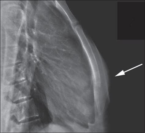 Broken Sternum X Ray