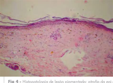 Figure 4 from LÍQUEN PLANO PILAR ASSOCIADO A LÍQUEN PLANO PIGMENTOSO