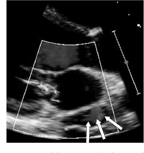 Figure 4 From Coumadin Ridge In The Left Atrium Demonstrated On Three