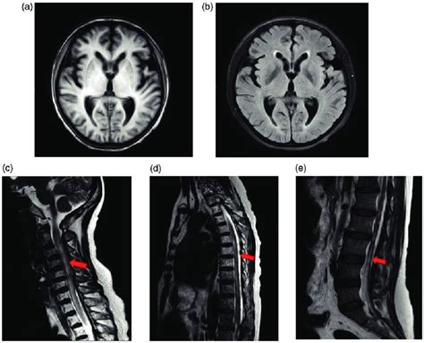 Magnetic Resonance Imaging Mri Scans Of A 50 Year Old Female Patient