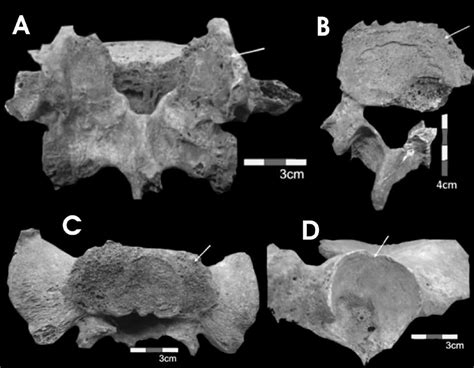 A Vértebra Lumbar L3 Con Presencia De Marcada Osteofitosis En El