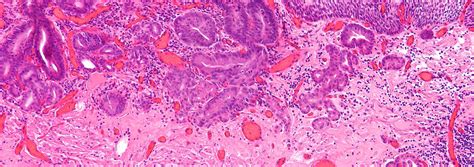 Progression of Esophageal Cancer | J. Craig Venter Institute