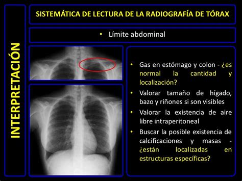 Diagnóstico Por Imágenes Radiografía De Tórax Normal