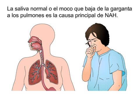 PatEdu Neumonía adquirida en el hospital NAH