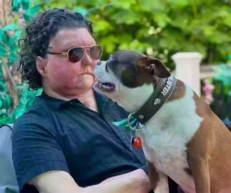 Man who had world’s first successful face and double hand transplant