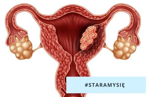 Rak Endometrium Objawy Rokowania Przerzuty