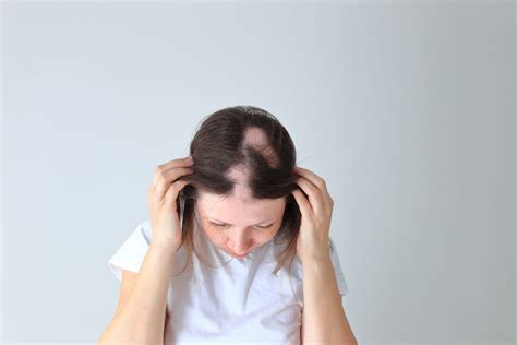 Medications That Cause Hair Loss Reveal The Top 17