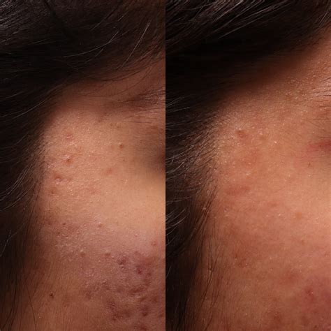 Hypertrophic Scars Treatment Before And After Scar Healing Institute