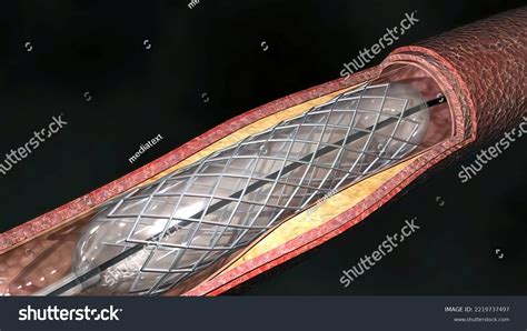 Atherosclerosis Disease Which Plaque Builds Inside Stock Illustration ...