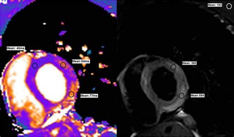 Myocardial T2 Mapping Is Better Than T2w Turbo Spin Echo For The