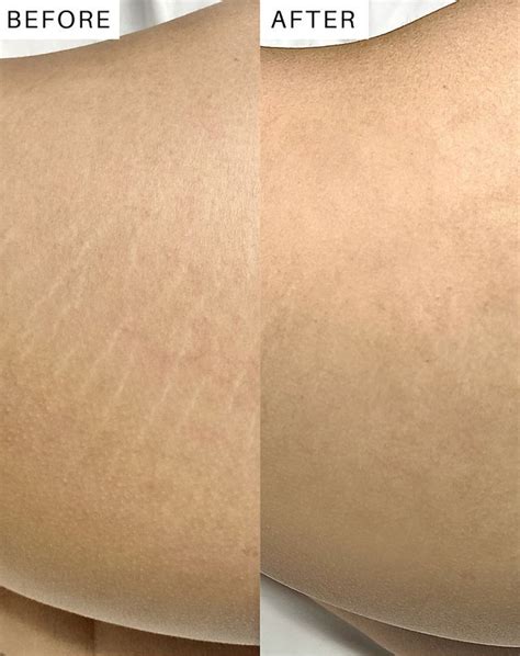 Stretch Marks Before And After