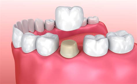 How Much Do Dental Crowns Usually Cost? - Los Angeles Dental Crown ...