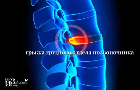 Грыжа грудного отдела позвоночника. Симптомы и лечение