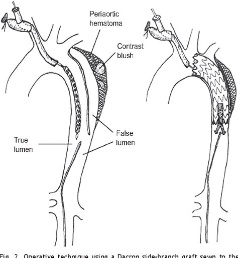 Figure 1 From Brief Communication Vascular Thoracic Endovascular