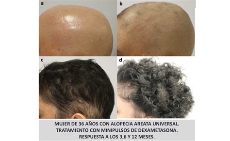 Alopecia Areata Solución causas problema tratamiento especialista