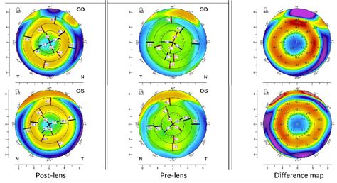 pearls  assessing myopia progression
