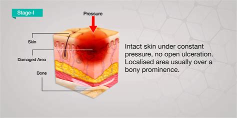 Skin Pressure Ulcer Stages