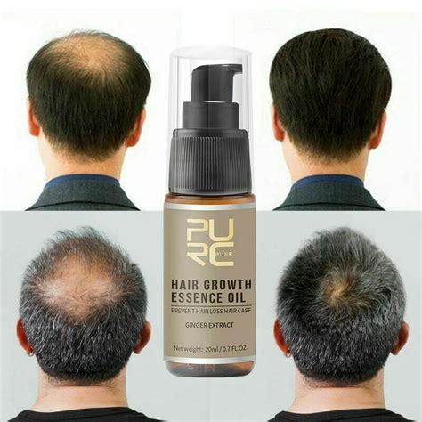 Buy Miracle Hair Growth Germinal Hair Growth Hairdressing Serum Oil ...