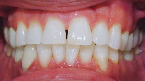 Class I Malocclusion Excessive Overjet Upper Spacing Lower Crowding Case Gallery