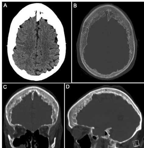 Hyperostosis Frontalis Interna Diagnosed After A Provoked Seizure