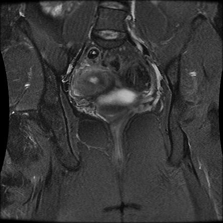 Unicornuate Uterus Radiology Case Radiopaedia Org