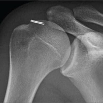 Orthopedic Management of Complications of Using Intraosseous Catheters ...