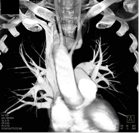 Right Aortic Arch With Aberrant Left