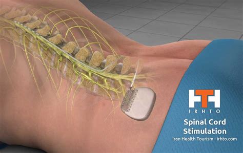 Spinal Cord Stimulation - IRAN Health Tourism Organizer - Iran Medical ...