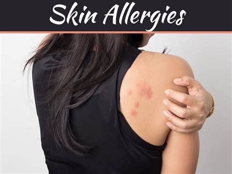 What Are The Different Kinds Of Skin Allergies Skin Allergies